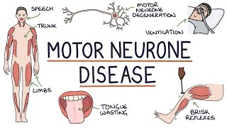 Understanding Motor Neurone Disease Amyotrophic Lateral Sclerosis [upl. by Husch]