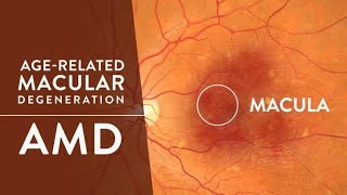 Age Related Macular Degeneration  Anti  VEGF  ARMD Patient Education amp Explanation [upl. by Arihppas]