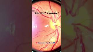 Smartphone Fundus Videography  Fundus Photography  Normal Fundus  Short Video 29 [upl. by Imoin]