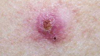 Basal Cell Carcinoma Symptoms Causes and Treatment  First Aid  Made Easy [upl. by Nilkcaj706]