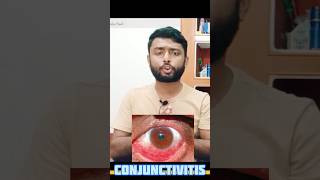 Conjunctivitis  কনজাংটিভাইটিস conjunctivitis conjunctivitistreatment allergicconjunctivitis [upl. by Bohlen265]