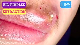 Mụn bọc môi toDermatologistpimples whitehead blackheadanti acnesevere pustule removal [upl. by Anemij125]