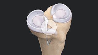 “FixandStitch” Augmented Posterior Meniscus Root Repair [upl. by Nosredna]