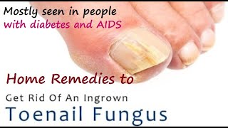 Home Remedies for Ingrown Toenail I How to Treat an Ingrown Toenail I How to Get Rid of Ingrown Toe [upl. by Davena]