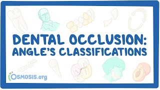 Dental occlusion  Angle’s classifications [upl. by Mathe]