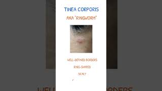 TINEA CORPORIS SYMPTOMS amp TREATMENT [upl. by Budworth]