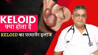 Get Rid Of Keloids Forever Effective Keloid Treatment By Dr Naren Pandey [upl. by Meesaw414]