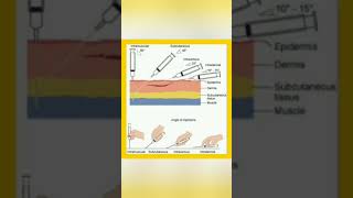 Route  technique of injection administration 💉knowledge easylearning shortsvideo shayari [upl. by Rafaellle]