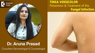 White Patches on Skin Is it TINEA VERSICOLOR  Is it Fungal  DrAruna Prasad  Doctors Circle [upl. by Monda531]