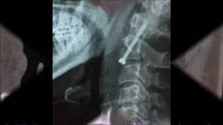 Odontoid Screw Fixation  HIMS Dehradun [upl. by Thorr]