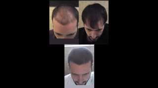 Time Lapse  18 months of hair loss treatment [upl. by Erick]