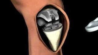 3D Medical Animation of a Knee Replacement [upl. by Torray]