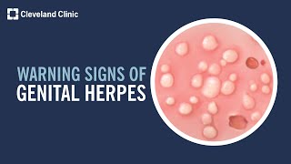 5 Warning Signs of Genital Herpes [upl. by Mitran]