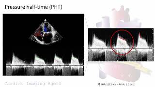 Evaluation of rheumatic mitral stenosis with advanced transthoracic echocardiography [upl. by Cully882]