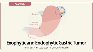 Exophytic and Endophytic Gastric Tumor [upl. by Clarance544]