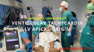 Emergency synchronized cardioversion in ventricular tachycardia VT LV apical origin [upl. by Chapin]