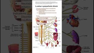 Lumbar sympathetic block [upl. by Dnalon]