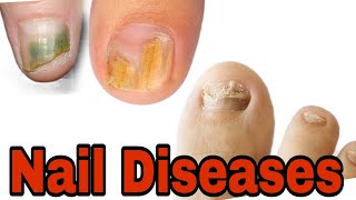 Nail diseases l Homoeopathy Medicine l Nail Fungus Treatment [upl. by Traver]