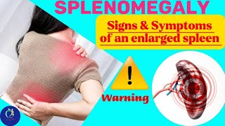 SPLENOMEGALYEnlarged SpleenSymptoms of an enlarged spleen Such as anemia abdominal painetc [upl. by Nimaj]