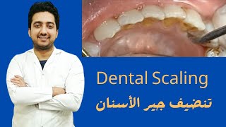 Dental Scaling And Polishing 1 [upl. by Monahan]