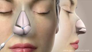 Rhinoplasty Nose Job Video Animation  Guncel Ozturk MD  DRGO [upl. by Htebirol]