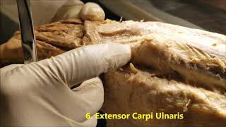 Extensor Wrist Tendons And Snuffbox DissectionSanjoy Sanyal [upl. by Solberg]