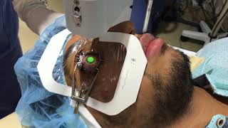 Collagen Cross Linking For keratoconus [upl. by Schinica152]