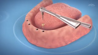 Dental Implants for a Toothless Jaw 3D medical animation [upl. by Nnoved]