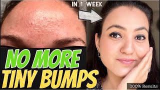 1 WEEK CHALLENGE 💕 GET RID OF TINY BUMPS NATURALLY in just 7 Days and Get Amazing EVEN SKINTONE [upl. by Jonathan548]