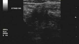 Spigelian Hernia Ultrasound [upl. by Merilyn]