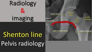 Radiological anatomy of pelvis  The Shenton Line [upl. by Ynafetse859]