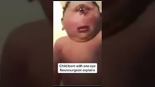 defect child born with conjoined eye neurosurgery neurosurgeon holoprosencephaly cyclopia [upl. by Oicirtap]