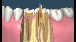 Endodoncija [upl. by Alwitt650]