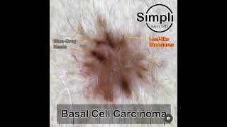 Pigmented Basal Cell Carcinoma [upl. by Adiaros]