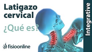 Latigazo cervical  ¿Qué es y cuáles son las claves de su solución [upl. by Htebaile906]