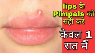 lips 👄 के Pimpal को केसे सही करे  how to remove lips Pimpals [upl. by Gustaf]