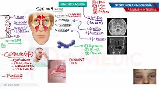 Otorrinolaringología  Sinusitis aguda [upl. by Horbal778]