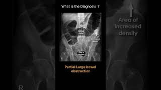 Partial Large bowel obstruction Abdominal Xray  Abnormalities 71 radiologychannel007 [upl. by Jewett300]