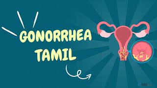 Gonorrhea in Tamil Definition Symptoms Causes Diagnosis and Management [upl. by Namzaj]