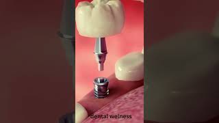 Get PERFECT Smiles with This Implant Placement Procedure shorts [upl. by Ahcsap]