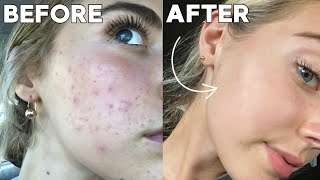 How I Cleared My Skin In 8 Weeks naturally [upl. by Llecrup]