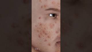 What Exactly Is Acne Causes of Acne 3D Animation [upl. by Fair]