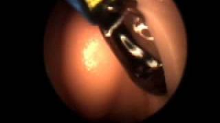 Balloon Sinuplasty for Chronic Sinusitis [upl. by Annocahs133]