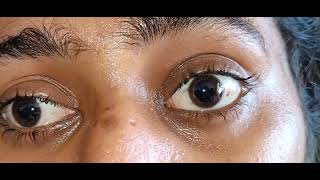 Complete Bilateral Ophthalmoplegia Video [upl. by Nylyrehc]