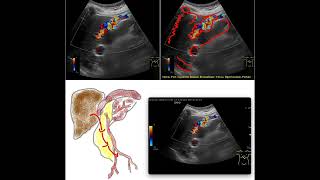 Medical imaging Recanalized round ligament Portal hypertension Liver [upl. by Neerroc]