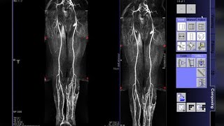 Periferik Anjio MR Nasıl Çekilir Abdominal Anjio Nasıl Çekilir Kanal Radyoloji MR Çekim Teknikleri [upl. by Trueman]