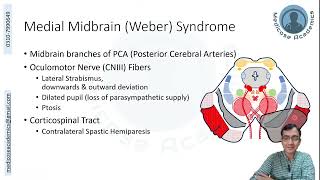 Midbrain Lesions [upl. by Ecenaj]