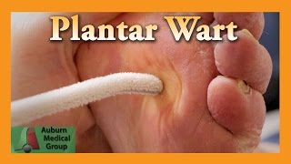 Plantar Wart Treatment  Auburn Medical Group [upl. by Nirhtak1]