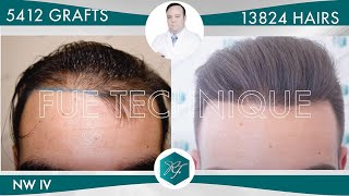 Injerto Capilar Técnica FUE – 5412 Grafts 13824 Pelos – Dr Rafael de Freitas [upl. by Leanne]