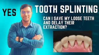 Dr Rudra Mohan  Can I Save my loose teeth  Find out here  PeriodontalTooth Splinting [upl. by Yhotmit]